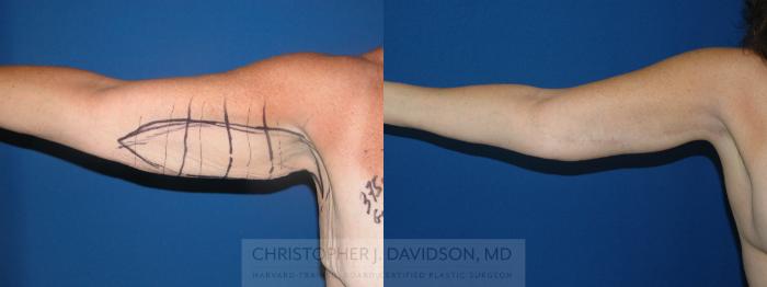 Arm Lift Case 164 Before & After View #1 | Boston, MA | Christopher J. Davidson, MD
