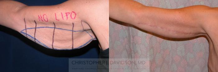 Arm Lift Case 171 Before & After View #1 | Boston, MA | Christopher J. Davidson, MD