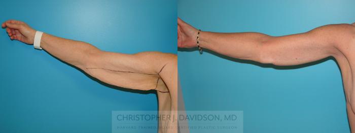 Arm Lift Case 205 Before & After View #1 | Boston, MA | Christopher J. Davidson, MD