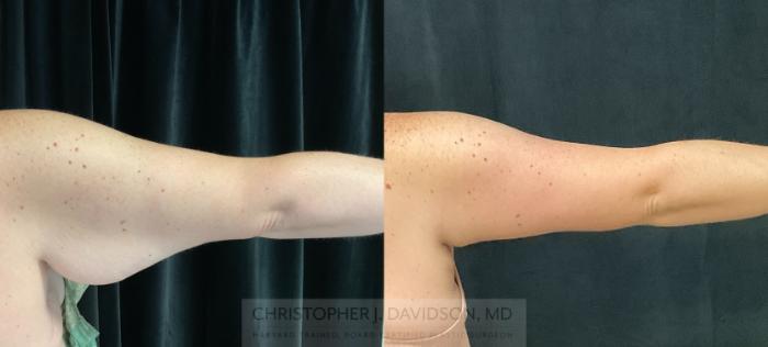 Arm Lift Case 320 Before & After Back - Right Arm | Boston, MA | Christopher J. Davidson, MD