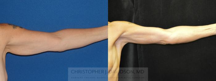 Arm Lift Case 45 Before & After View #1 | Boston, MA | Christopher J. Davidson, MD