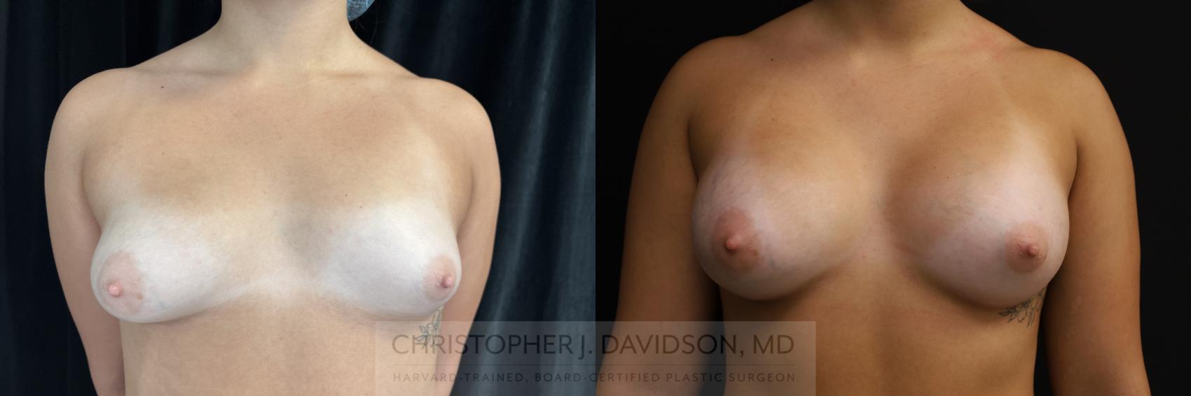 Breast Augmentation Case 469 Before & After Front | Boston, MA | Christopher J. Davidson, MD
