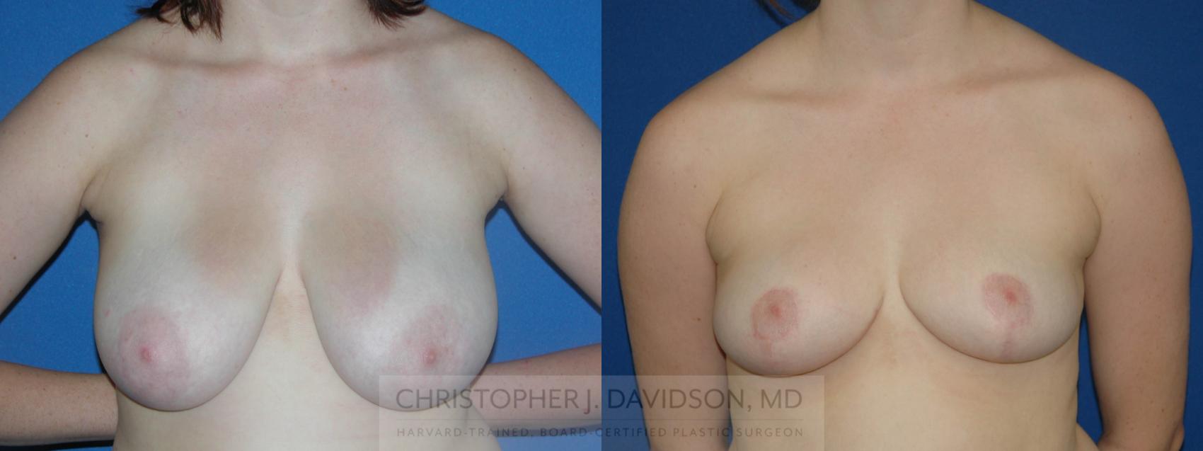 Breast Reduction Case 135 Before & After View #1 | Boston, MA | Christopher J. Davidson, MD