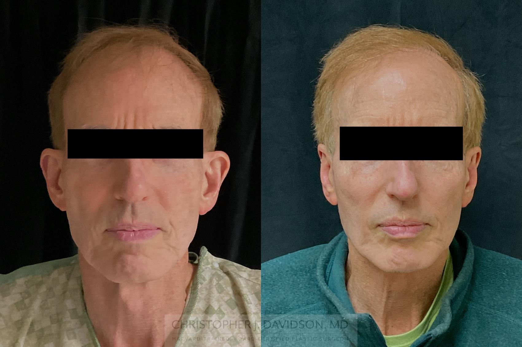 Ear Surgery (Otoplasty) Case 471 Before & After Front | Boston, MA | Christopher J. Davidson, MD