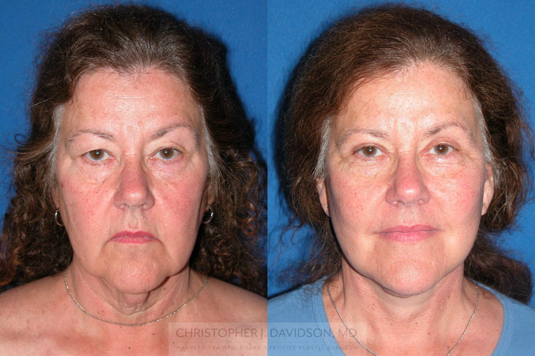 Facelift Surgery Case 210 Before & After View #1 | Boston, MA | Christopher J. Davidson, MD