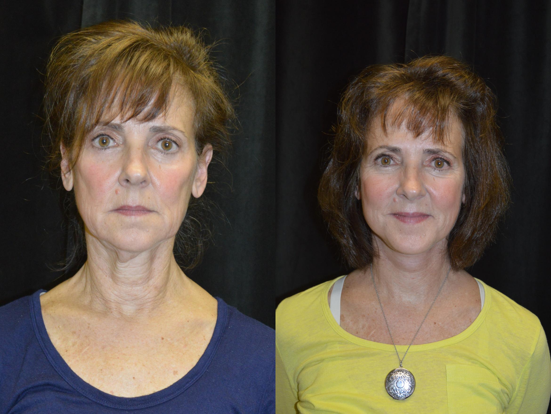 Facelift Surgery Case 231 Before & After View #1 | Wellesley, MA | Christopher J. Davidson, MD