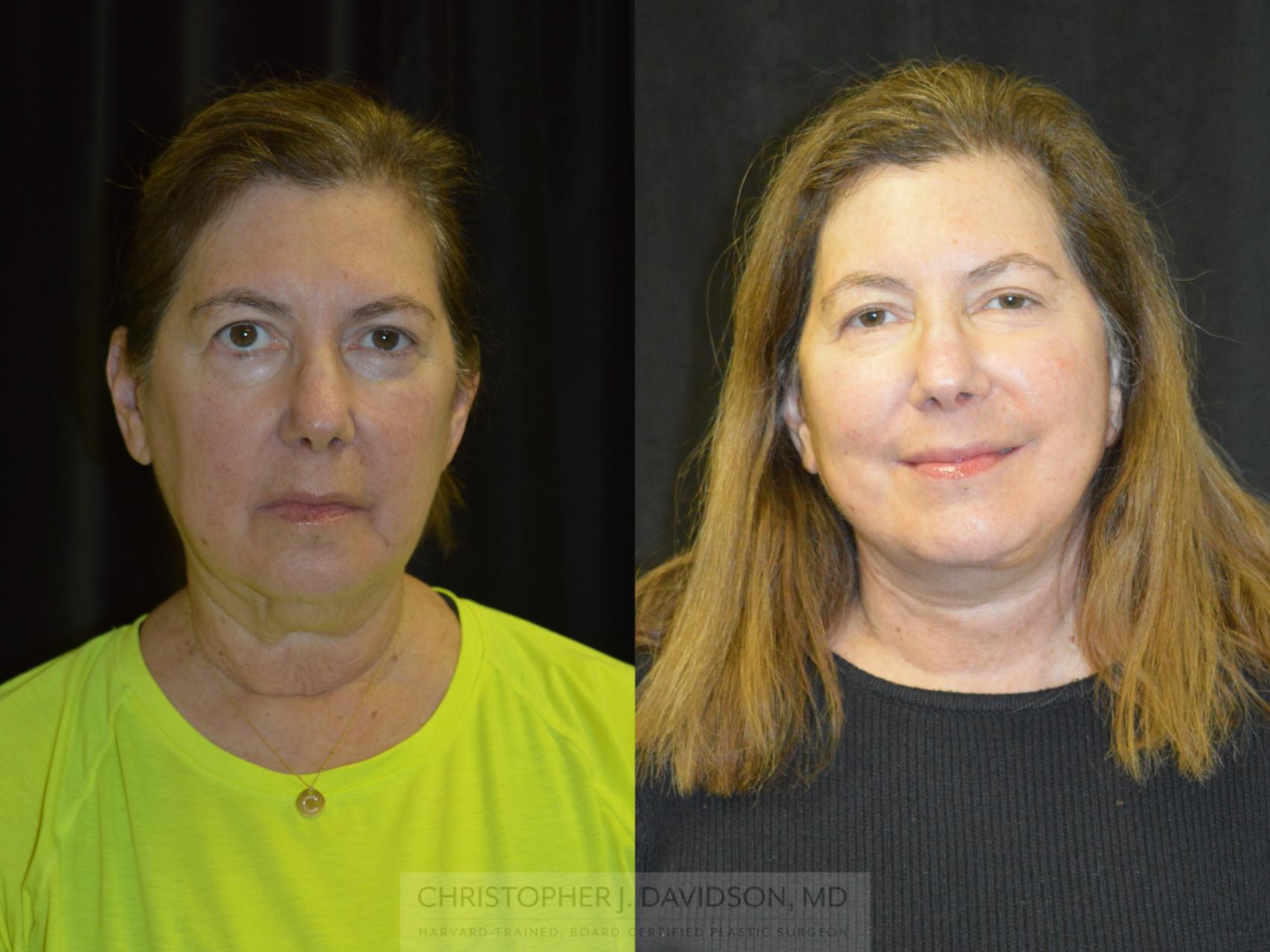 Facelift Surgery Case 237 Before & After View #1 | Boston, MA | Christopher J. Davidson, MD