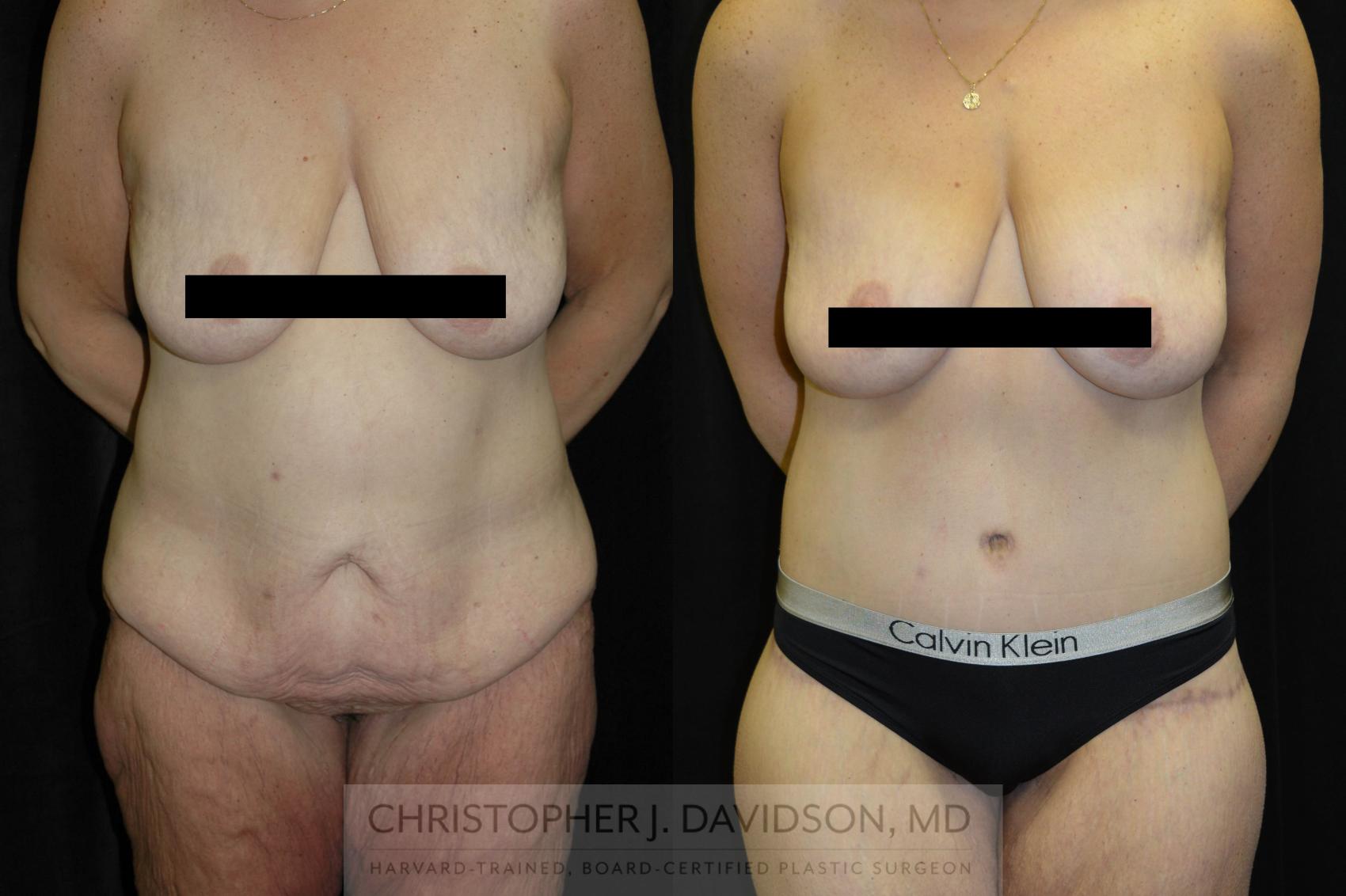 Lower Body Lift Case 72 Before & After View #1 | Wellesley, MA | Christopher J. Davidson, MD