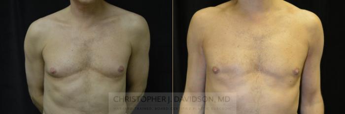 Male Breast Reduction Case 126 Before & After View #1 | Boston, MA | Christopher J. Davidson, MD