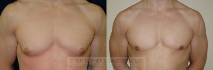 Male Breast Reduction Case 144 Before & After View #1 | Boston, MA | Christopher J. Davidson, MD