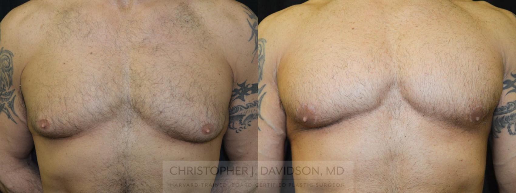 Male Breast Reduction Case 23 Before & After View #1 | Boston, MA | Christopher J. Davidson, MD