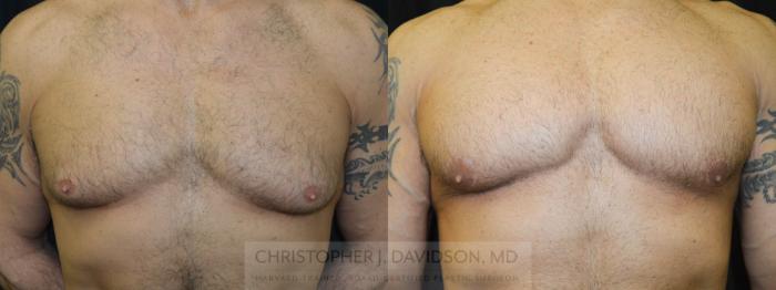Male Breast Reduction Case 23 Before & After View #1 | Boston, MA | Christopher J. Davidson, MD