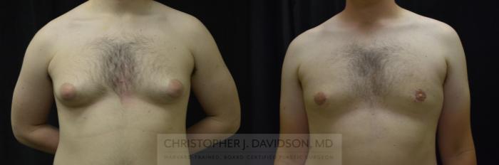 Male Breast Reduction Case 249 Before & After View #1 | Boston, MA | Christopher J. Davidson, MD