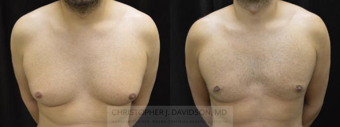 Male Breast Reduction Case 61 Before & After View #1 | Boston, MA | Christopher J. Davidson, MD