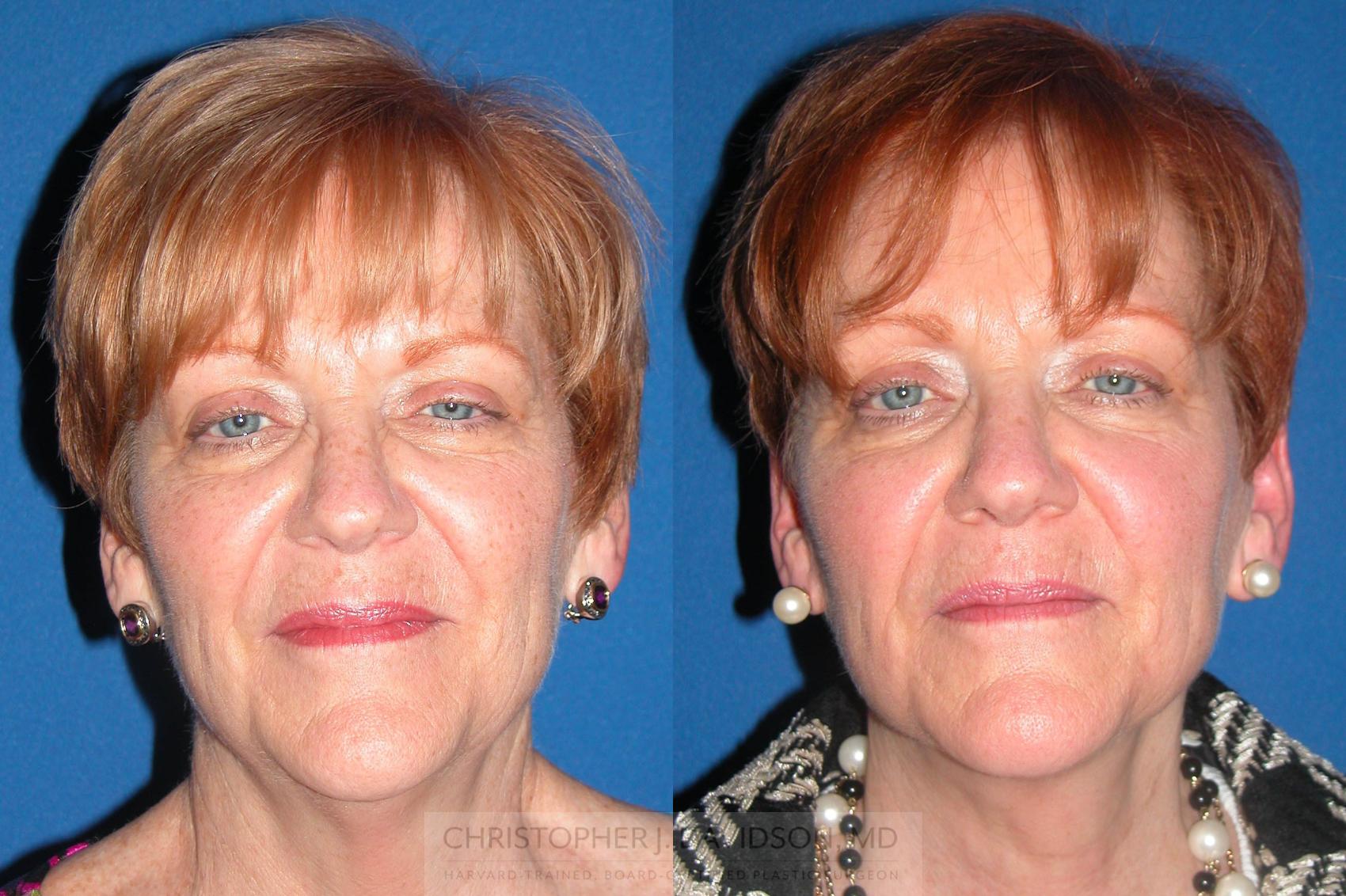 Neck Lift Case 76 Before & After View #1 | Boston, MA | Christopher J. Davidson, MD