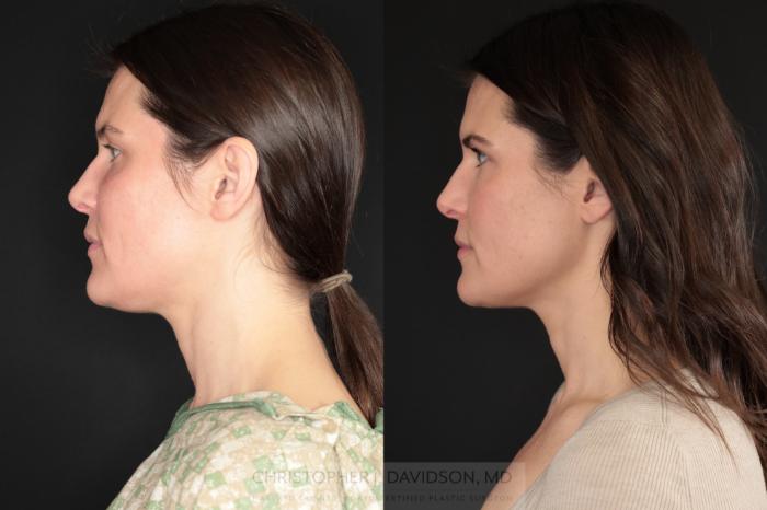 Submental Liposuction Case 479 Before & After Left Side | Boston, MA | Christopher J. Davidson, MD