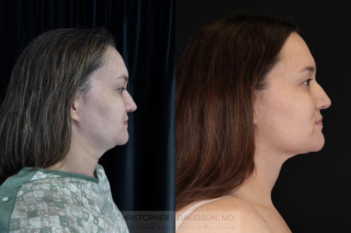 Submental Liposuction Case 484 Before & After Right Side | Boston, MA | Christopher J. Davidson, MD