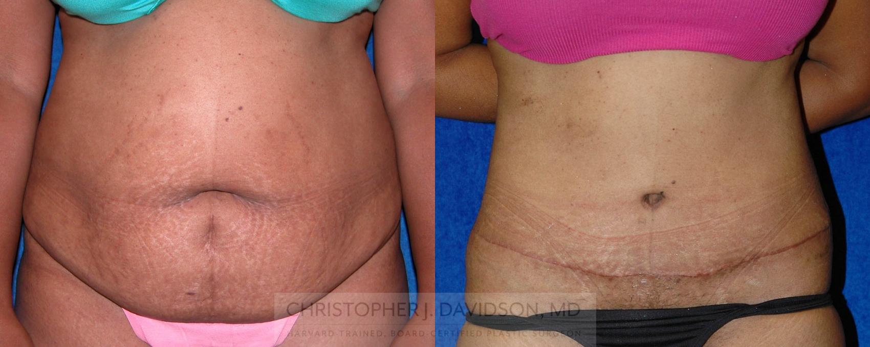 Tummy Tuck (Abdominoplasty) Case 10 Before & After View #1 | Boston, MA | Christopher J. Davidson, MD
