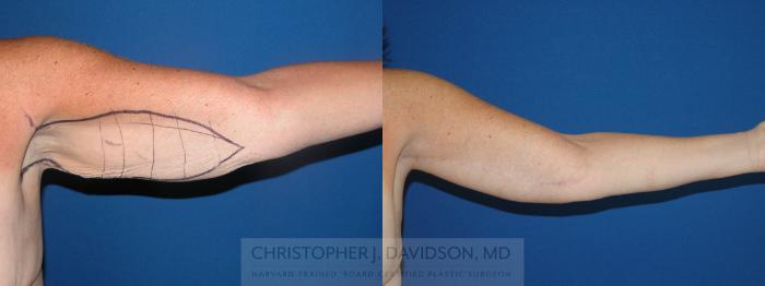 Arm Lift Case 164 Before & After View #2 | Boston, MA | Christopher J. Davidson, MD