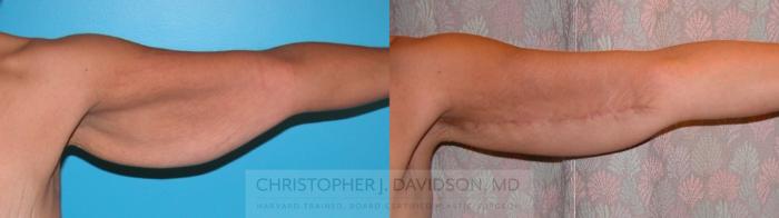 Arm Lift Case 171 Before & After Left Side | Boston, MA | Christopher J. Davidson, MD