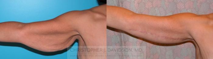 Arm Lift Case 171 Before & After Right Side | Boston, MA | Christopher J. Davidson, MD