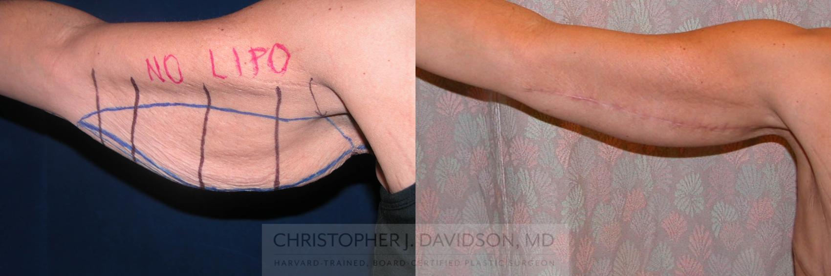 Arm Lift Case 171 Before & After View #1 | Wellesley, MA | Christopher J. Davidson, MD