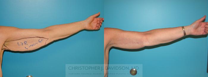 Arm Lift Case 205 Before & After View #2 | Boston, MA | Christopher J. Davidson, MD
