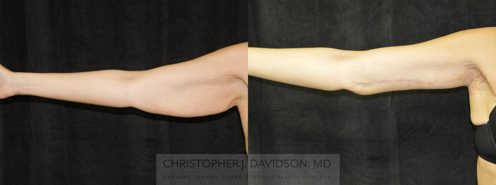 Arm Lift Case 25 Before & After View #1 | Boston, MA | Christopher J. Davidson, MD