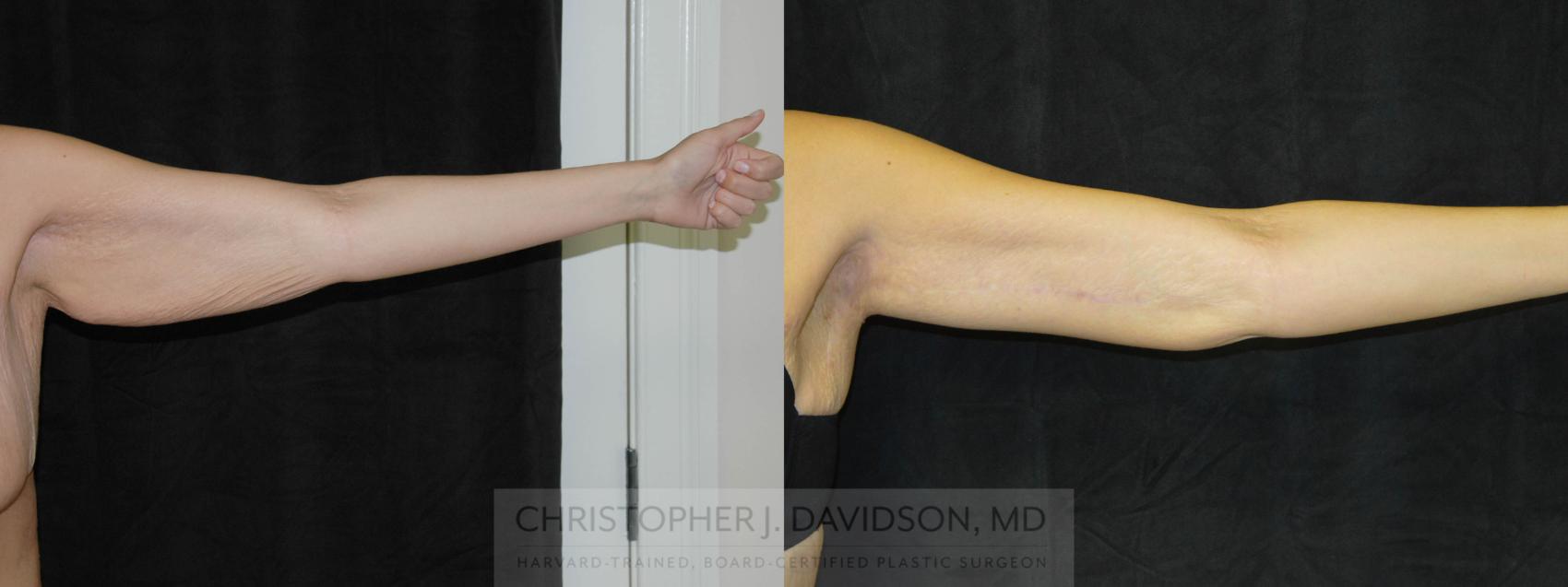 Arm Lift Case 25 Before & After View #2 | Wellesley, MA | Christopher J. Davidson, MD