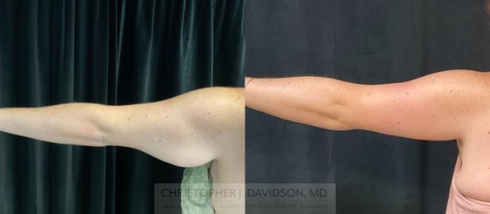 Arm Lift Case 320 Before & After Back - Left Arm | Boston, MA | Christopher J. Davidson, MD