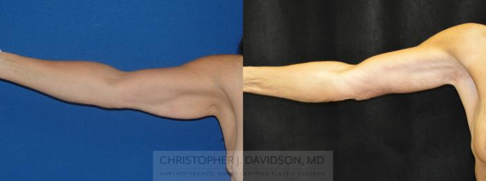 Arm Lift Case 45 Before & After View #2 | Boston, MA | Christopher J. Davidson, MD