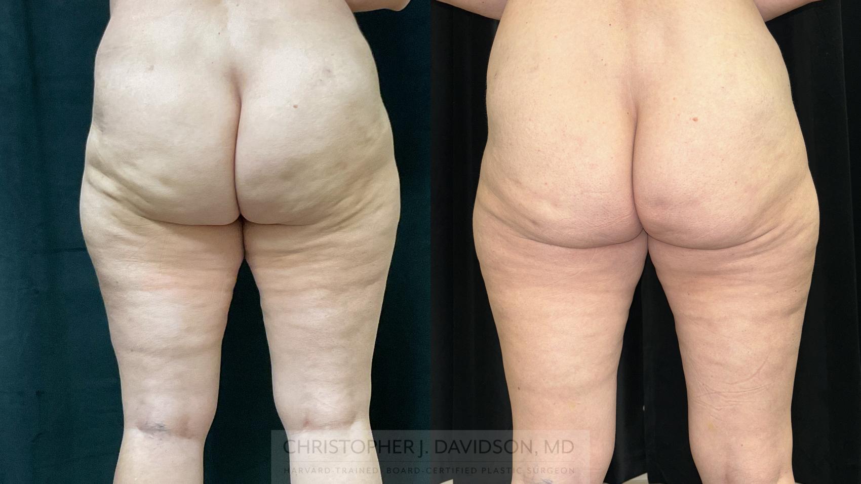 Avéli Case 408 Before & After Back | Boston, MA | Christopher J. Davidson, MD