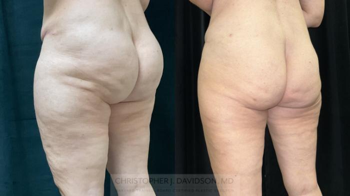 Avéli Case 408 Before & After Left Oblique | Boston, MA | Christopher J. Davidson, MD