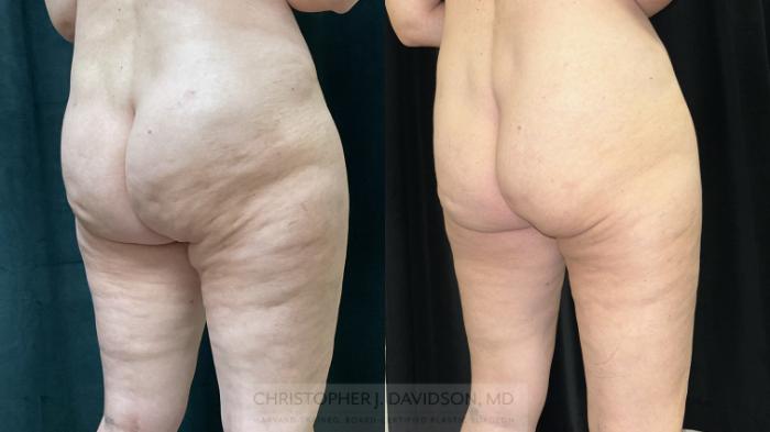 Avéli Case 408 Before & After Right Oblique | Boston, MA | Christopher J. Davidson, MD