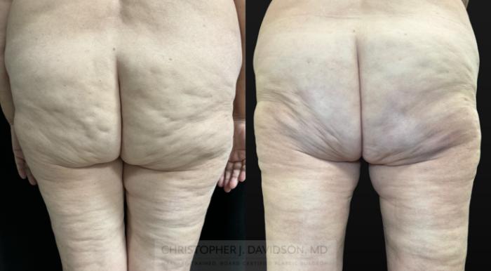 Avéli Case 468 Before & After Back | Boston, MA | Christopher J. Davidson, MD