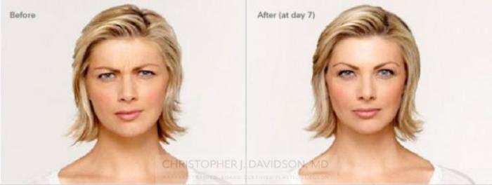 BOTOX® Cosmetic Case 2 Before & After View #1 | Boston, MA | Christopher J. Davidson, MD