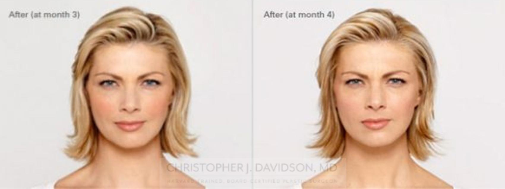 BOTOX® Cosmetic Case 2 Before & After View #2 | Wellesley, MA | Christopher J. Davidson, MD