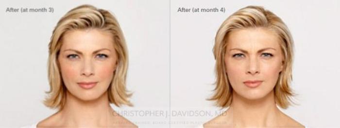BOTOX® Cosmetic Case 2 Before & After View #2 | Boston, MA | Christopher J. Davidson, MD