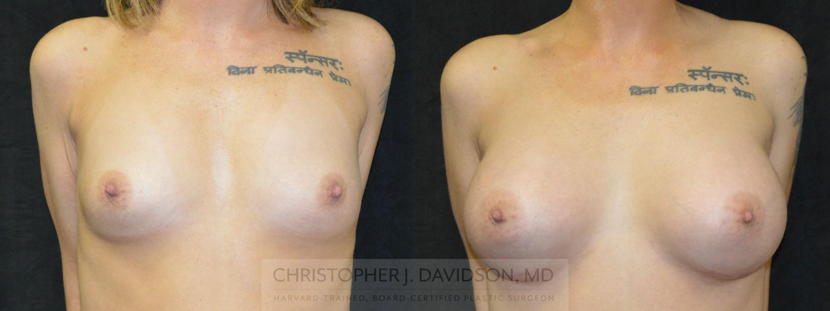 Breast Augmentation Case 102 Before & After View #1 | Boston, MA | Christopher J. Davidson, MD