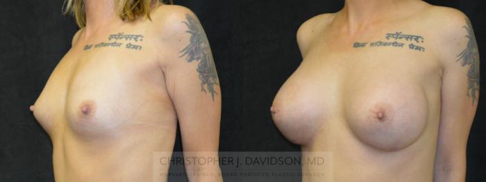 Breast Augmentation Case 102 Before & After View #2 | Boston, MA | Christopher J. Davidson, MD