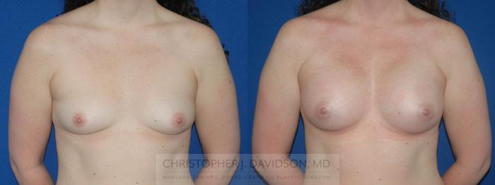 Breast Augmentation Case 103 Before & After View #1 | Boston, MA | Christopher J. Davidson, MD