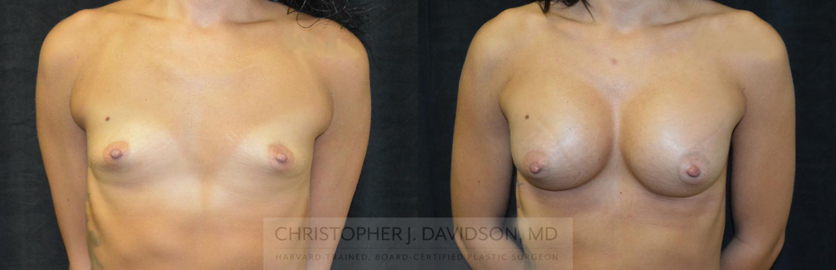 Breast Augmentation Case 115 Before & After View #1 | Wellesley, MA | Christopher J. Davidson, MD