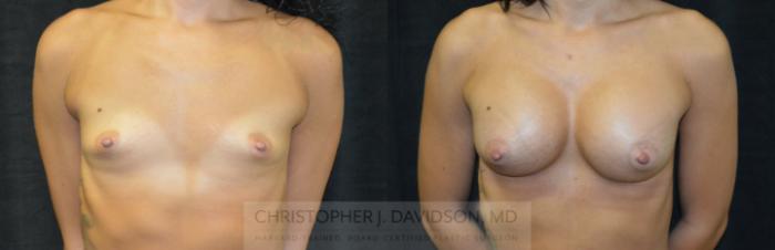 Breast Augmentation Case 115 Before & After View #1 | Boston, MA | Christopher J. Davidson, MD