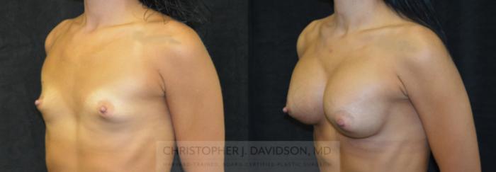 Breast Augmentation Case 115 Before & After View #2 | Boston, MA | Christopher J. Davidson, MD