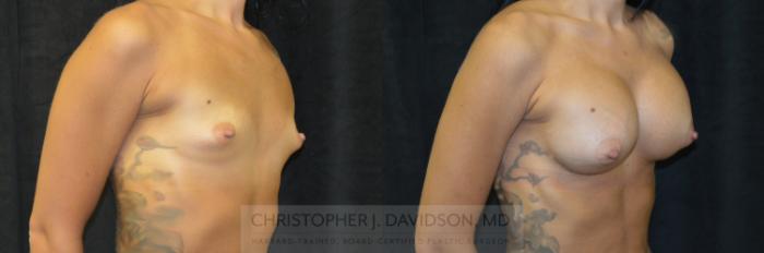 Breast Augmentation Case 115 Before & After View #3 | Boston, MA | Christopher J. Davidson, MD