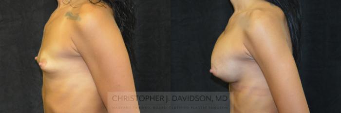 Breast Augmentation Case 115 Before & After View #4 | Boston, MA | Christopher J. Davidson, MD
