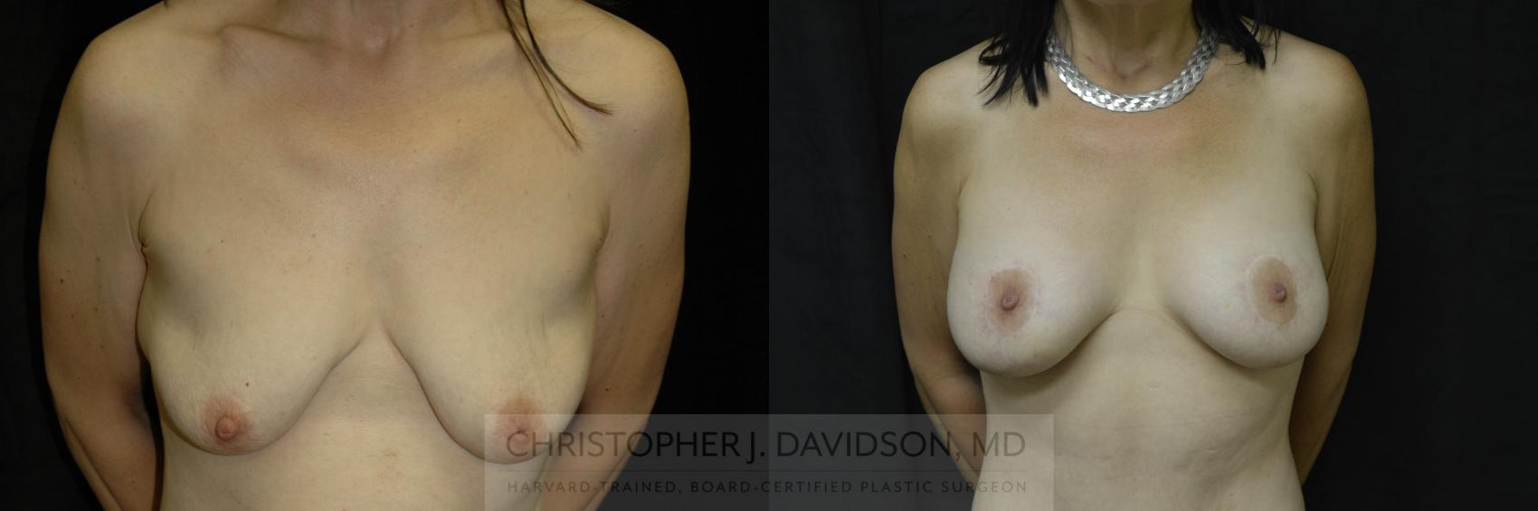 Breast Augmentation Case 118 Before & After View #1 | Boston, MA | Christopher J. Davidson, MD