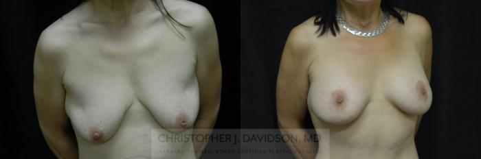 Breast Augmentation Case 118 Before & After View #2 | Boston, MA | Christopher J. Davidson, MD