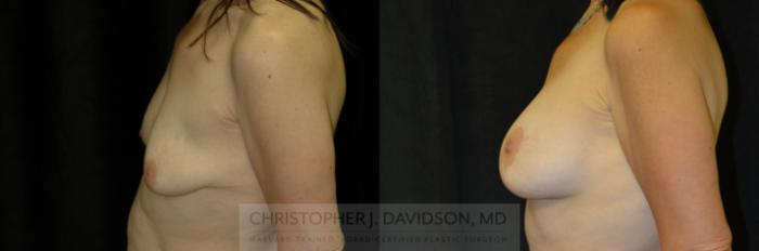 Breast Augmentation Case 118 Before & After View #3 | Boston, MA | Christopher J. Davidson, MD