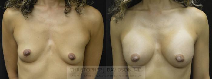 Breast Augmentation Case 12 Before & After View #1 | Boston, MA | Christopher J. Davidson, MD